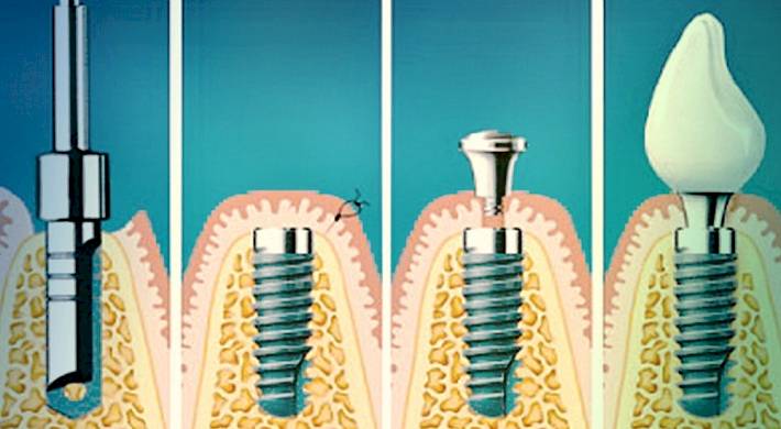 как устанавливаются зубные импланты, стоимость установки, какие есть виды Как устанавливаются зубные импланты - стоимость установки + какие есть виды