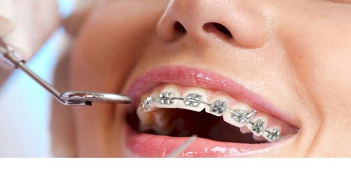 поставить брекеты на зубы, стоимость установки, процедура выравнивания зубов Поставить брекеты на зубы - стоимость установки + процедура выравнивания зубов
