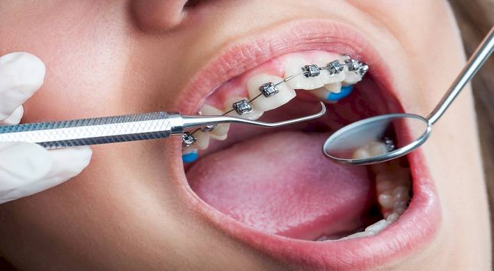 поставить брекеты на зубы, стоимость установки, процедура выравнивания зубов Поставить брекеты на зубы - стоимость установки + процедура выравнивания зубов