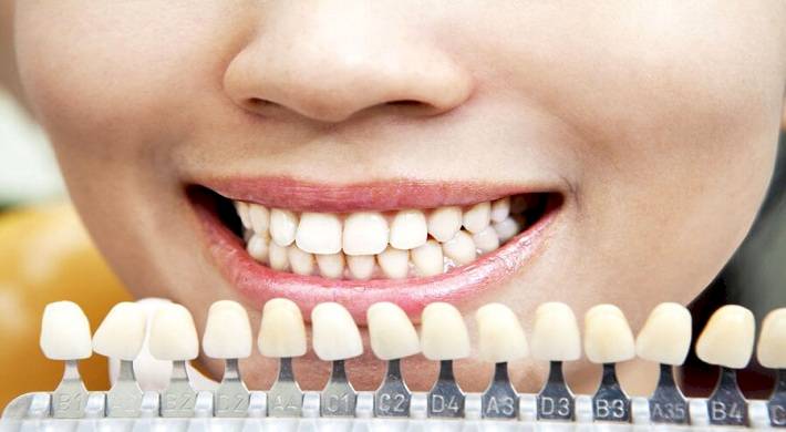 виниры, вред зубам, знать потребителю Виниры и вред зубам - что нужно знать потребителю