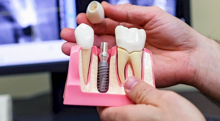 Как устанавливаются зубные импланты - стоимость установки + какие есть виды