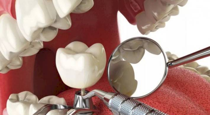 Проблемы с зубным протезированием и имплантами: Можно ли вернуть деньги или обязать устранить